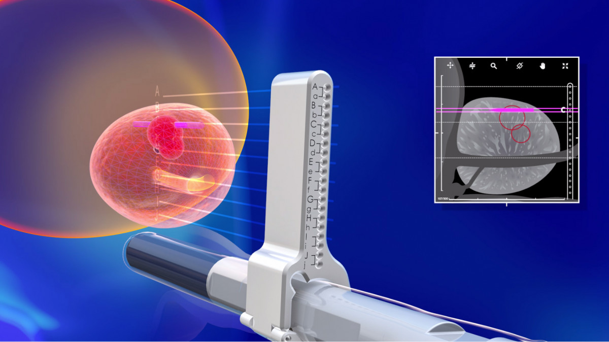 Trinity® Mrius Obt Fusion® Prostate Biopsy System Urology Kebomed